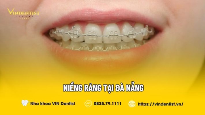 Niềng răng tại Đà Nẵng bao nhiêu tiền?
